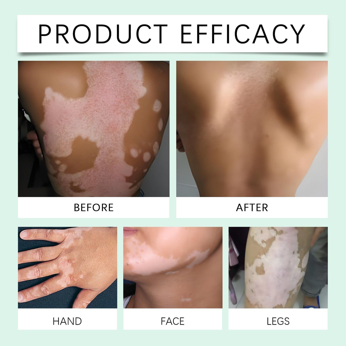 Vitiligo Herbal Cream